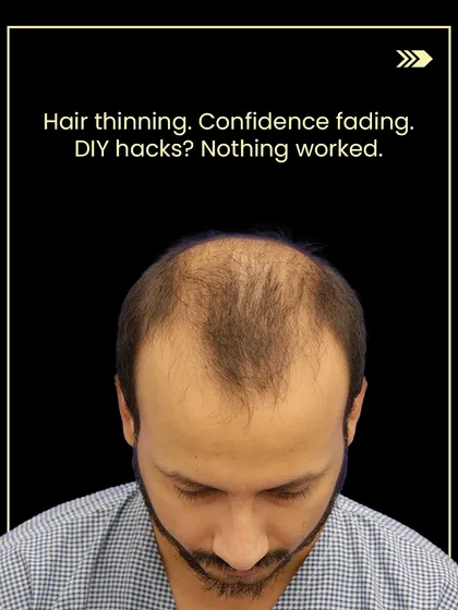 Dhruv came to us after trying various DIY hacks for his thinning hair that didn't work. This was his hair condition before starting treatment.