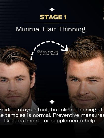 Stage 1 of hair loss is characterized by minimal thinning at the temples, with the hairline remaining largely intact. At this early stage, preventive measures like supplements or treatments can be very effective.