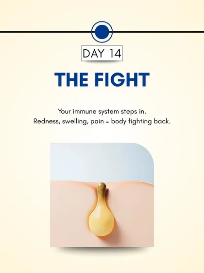 Day 14: Your body's immune system recognizes the bacterial invasion and starts to fight back. This immune response is what causes the redness, swelling, and pain associated with a developing pimple.