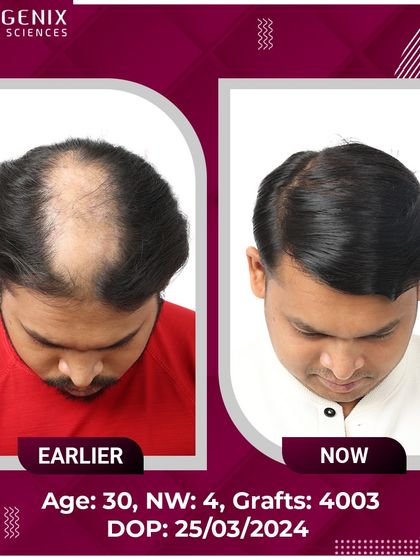 Witness the life-changing results for this 30-year-old after a 4003-graft procedure for Grade 4 baldness.