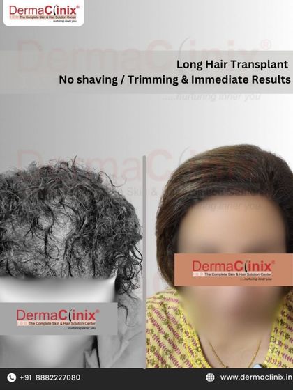 This before and after image showcases a female Long Hair Transplant. This technique provides immediate results without the need for shaving, making it a preferred choice for women seeking discreet hair restoration.