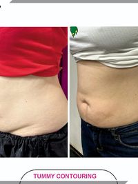 Weight Loss & Body Contouring