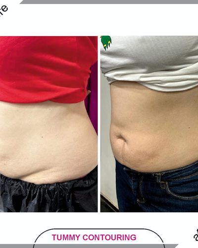 Weight Loss & Body Contouring