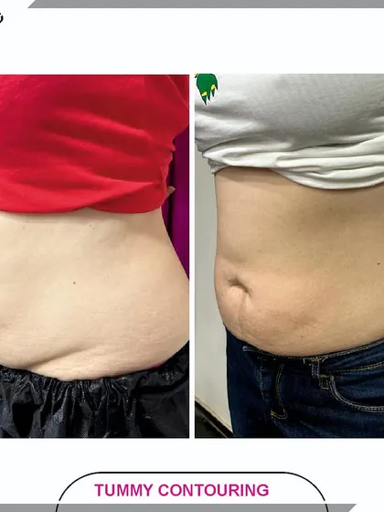 This is the result of our Tummy Contouring program after just one session of Cristal Pro. We focus on reducing stubborn belly fat and tightening the skin, helping our clients feel more confident and comfortable.