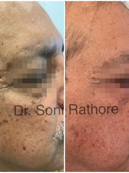This angle further demonstrates the effectiveness of a single laser treatment for sun damage and age spots. Continued sessions and diligent sun protection will enhance and maintain these results.