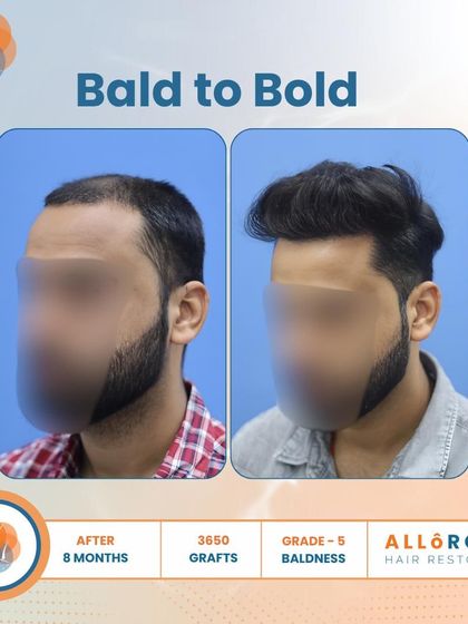 From Bald to Bold. This 8-month result for a Grade 5 case, using 3650 grafts, shows a complete transformation. The close-up of the hairline demonstrates the natural and dense packing of follicles.