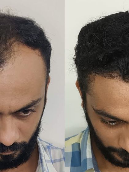 Looking down, you can see how the density in the frontal region was significantly improved, eliminating the appearance of thinning.