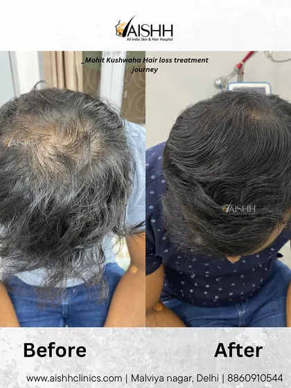 A slightly different angle of the same patient's two-month non-surgical treatment progress, highlighting the significant reduction in visible scalp.