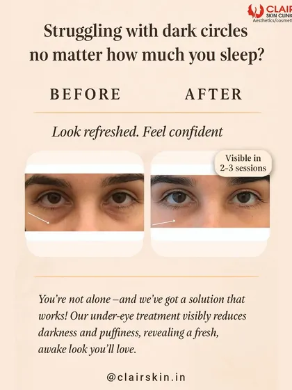 Tired of looking tired? Our under-eye treatment visibly reduces darkness and puffiness. This before and after shows a refreshed, more awake appearance after just a few sessions.