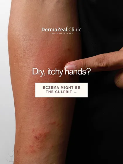 Persistent dry, itchy, and inflamed skin on your hands or body is often more than just simple dryness. It could be hand dermatitis or eczema, a condition that requires a proper diagnosis to manage effectively and prevent future flare-ups.