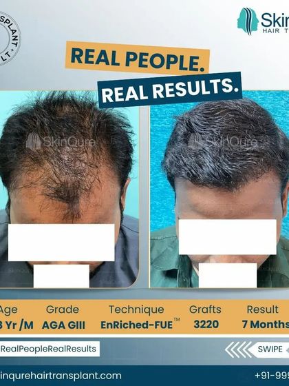This 28-year-old patient had AGA GIII hair loss. After 7 months and 3220 grafts, his hairline is completely restored, and the density in the frontal region provides excellent coverage. This is a great example of what can be achieved in a relatively short time.