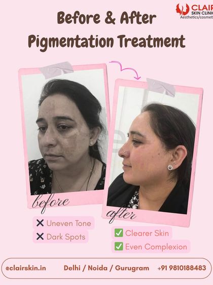 This client's journey shows a significant reduction in dark spots and uneven tone. Our pigmentation treatments work to create a clearer, more even complexion you can feel proud of.