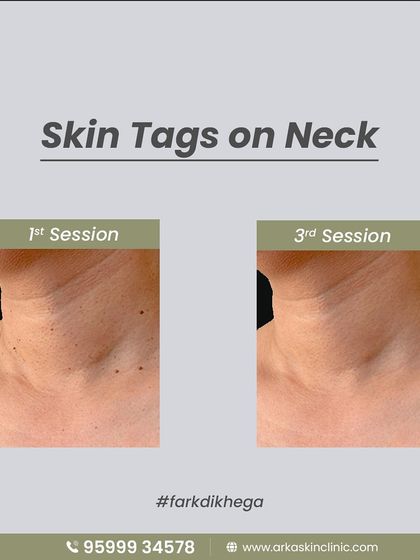 Skin tags on the neck are common and can be easily and safely removed. This before and after shows a clear improvement after just three sessions, resulting in smoother skin.