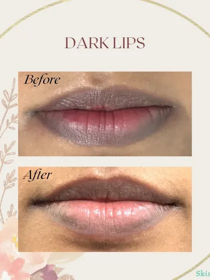 Dark lips can be caused by various factors, and I address them with targeted treatments. This result was achieved with a Q-switched Nd:YAG laser over two sessions, effectively lightening the lip hyperpigmentation for a more even tone.