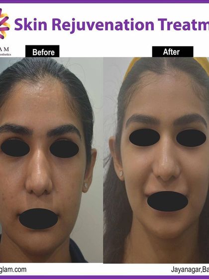 Following a GFC (Growth Factor Concentrate) skin rejuvenation treatment, this client's skin appears visibly brighter and more radiant. This procedure helps improve overall skin health and vitality.