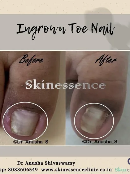 An ingrown toenail can be extremely painful, but the solution is often a quick, in-clinic procedure. This before-and-after shows the correction of the nail plate, providing immediate relief and preventing recurrence.