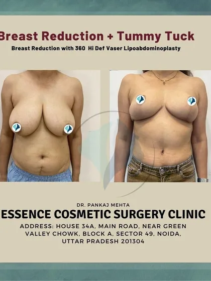 This image showcases a Mommy Makeover, a combination of procedures designed to restore the pre-pregnancy body. In this case, we performed a breast reduction along with a 360 Hi-Def Vaser Lipoabdominoplasty to create a more balanced and contoured silhouette.