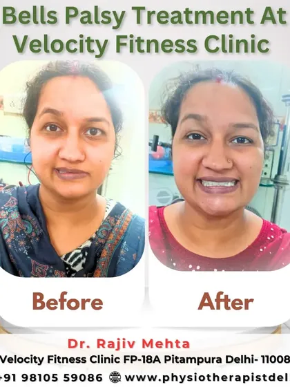This is one of the most rewarding parts of my work. This patient came to me for Bell's Palsy treatment, and this before and after image shows the incredible progress we made together, restoring her smile and facial control.