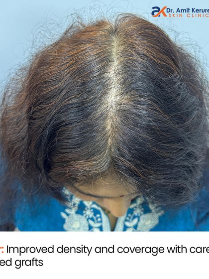 A closer look at the 'after' result reveals improved density and coverage achieved with carefully placed grafts. The new hair has successfully grown on the previously scarred scalp.