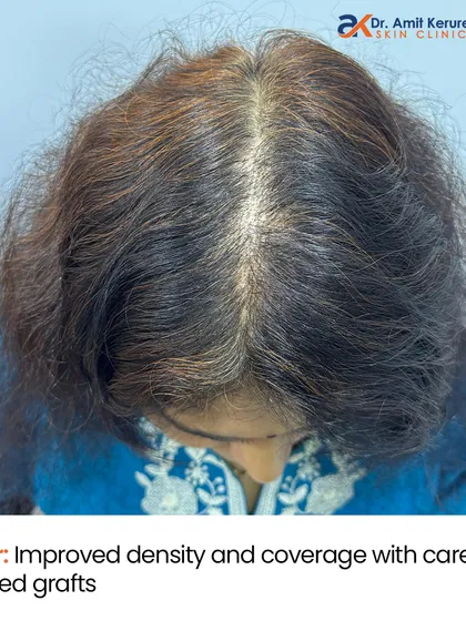 A closer look at the 'after' result reveals improved density and coverage achieved with carefully placed grafts. The new hair has successfully grown on the previously scarred scalp.