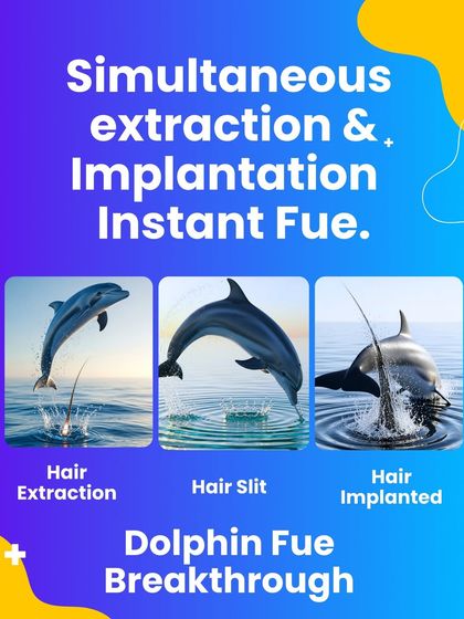The 'Dolphin FUE' breakthrough is our name for the Instant FUE technique. By minimizing the time the graft is outside the body, we ensure higher survival rates and faster growth.