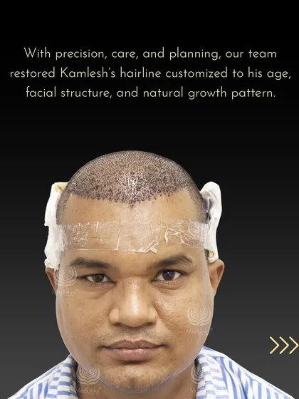 Immediately after the procedure, where our team restored Kamlesh's hairline, customized to his age and facial structure.