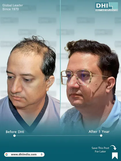 This three-quarter view highlights the impressive hair growth and restored confidence one year post-transplant. The result is dense, natural, and completely transformative for the client.