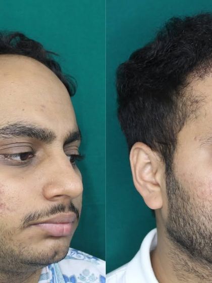 A final look at this patient's successful hairline restoration. The density and placement of the grafts ensure a result that will last a lifetime.