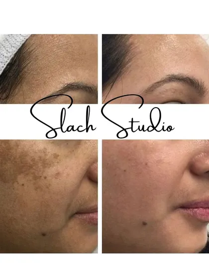 Another powerful example of pigmentation and sun spot removal, resulting in a clear and even skin tone.