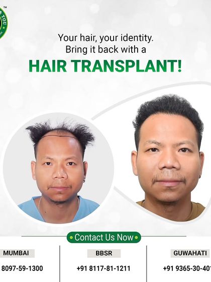 This before and after comparison is a testament to the power of FUE. The client's hair is not just restored; his entire look is revitalized, showcasing a natural and confident result.