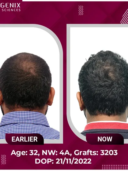 The top choice for natural restoration, this 32-year-old's Grade 4A hair loss was treated with 3203 grafts.