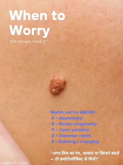 The ABCDEs are a simple guide to know when to worry about a mole. If you notice Asymmetry, Border irregularity, Color variation, a Diameter over 6mm, or any Evolution, it is time to get it checked.
