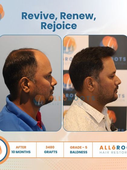Revive, Renew, Rejoice. This 10-month result for a Grade 5 baldness case, using 3480 grafts, shows a complete restoration. The images from all angles prove that a full head of hair is an achievable goal.