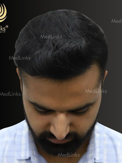 The top-down view after the transplant, showcasing the full coverage achieved.