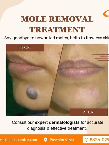 This is a clear example of a successful mole removal. Using a safe and effective technique, I was able to remove the unwanted mole from the chin area, leaving behind clear skin. The procedure is quick and the results are permanent.