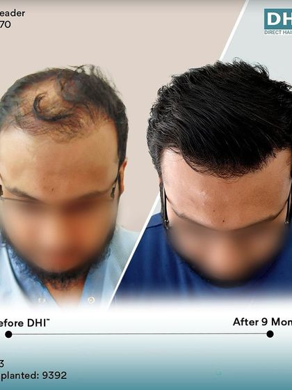 A before and after of a 33-year-old client 9 months post-procedure. With an impressive 9,392 hairs implanted, his hair is now incredibly dense and his hairline is perfectly restored.