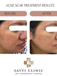 Acne & Scar Treatment