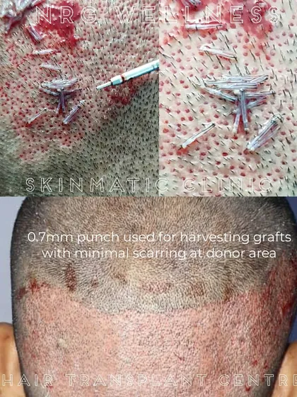 Our technique is built on precision. We use a 0.7mm punch to harvest hair grafts, which is a key reason our FUE procedure results in minimal scarring and faster healing for the donor area on the scalp.