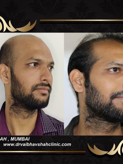 A side view showing the newly established hairline and how it blends into the rest of his hair.