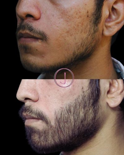 Acne & Scar Revision