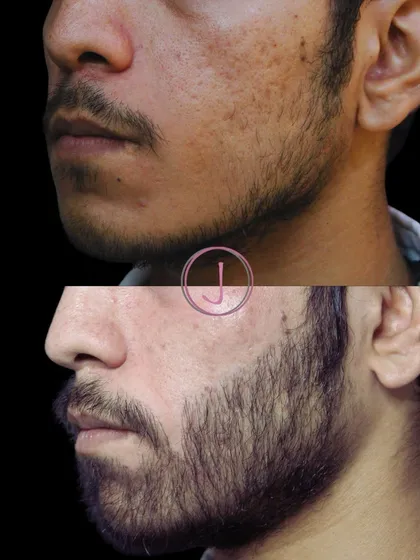 Acne scars tell a story, and each one requires a unique approach. For this patient, we focused on reducing the depth and pigmentation of pitted scars on the cheek and jawline, resulting in a smoother and more even skin texture.