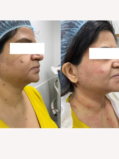 This before-and-after photo showcases the results of our skin tightening and rejuvenation treatments. We use the latest technology to deliver visible improvements and help you feel more confident.