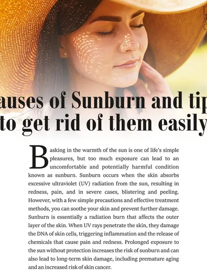 My article on the causes of sunburn and tips to treat it, covering everything from hydration to the right skincare products.