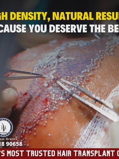 High density and natural results are what you deserve. This close-up of the implantation process shows how we carefully place each graft to mimic natural hair growth patterns.