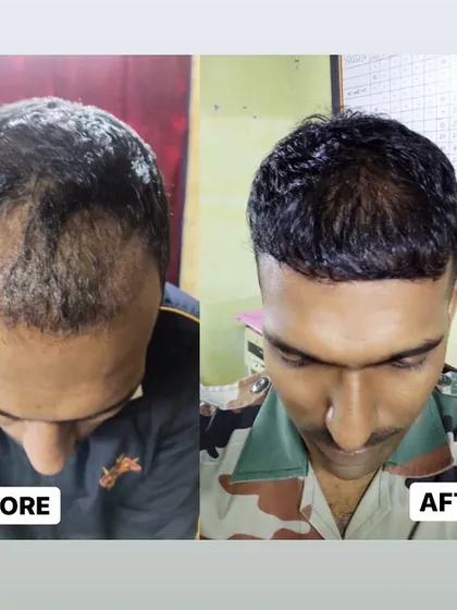 We are proud to serve clients from all walks of life. This shows the 5-month progress for a member of the armed forces, demonstrating significant new growth and coverage after his FUE procedure.