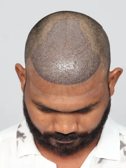 A 10-month transformation for a patient with diffuse pattern baldness. With 2400 grafts, we restored his look and confidence.