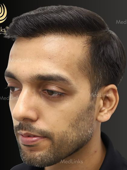 The after shot shows a restored hairline that is age-appropriate and natural. The hair flows seamlessly, making the transplant completely undetectable.