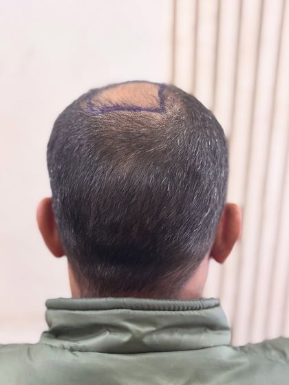 A view of the donor area and the crown area marked for transplant.