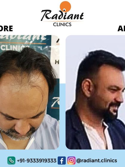 A striking before-and-after comparison. The patient's appearance is completely transformed with a new, dense hairline and restored volume, giving him a much more confident profile.