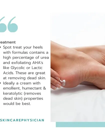 For active treatment, spot-treat your heels with a cream containing a high percentage of urea and exfoliating acids like glycolic or lactic acid to remove dead skin.